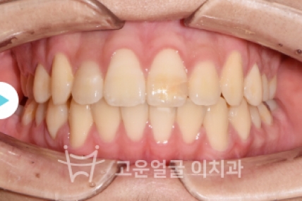 치료후기 이미지